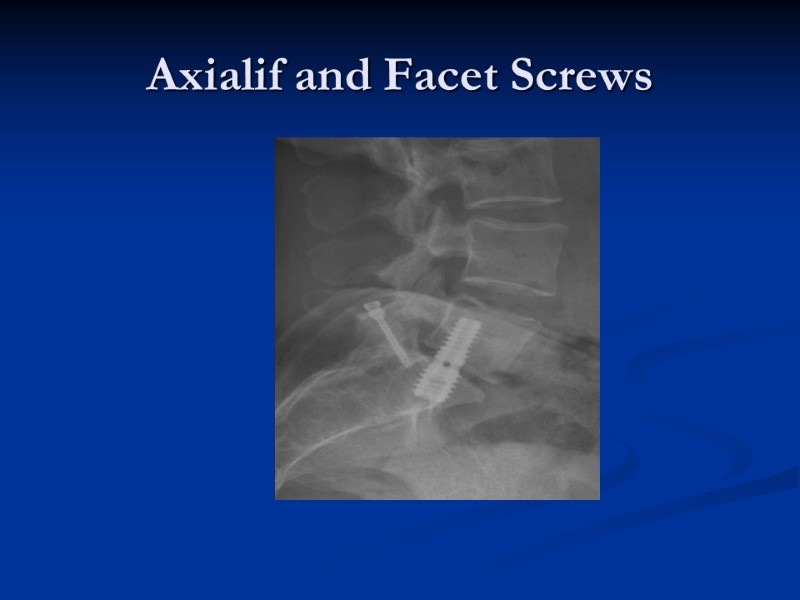 Axialif and Facet Screws